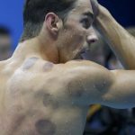 phelps-cupping-1170×658